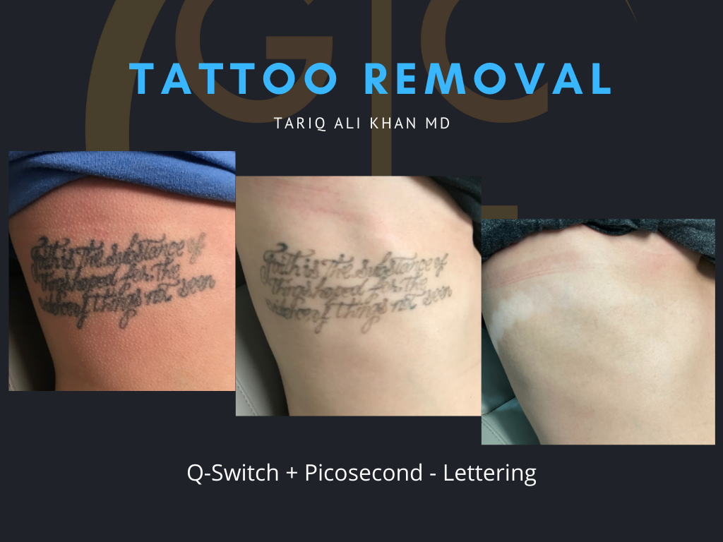 Gentle Care Laser Tustin & Long Beach Before and After picture - Tattoo Removal Mucosal Surface